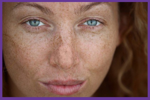 What is Hyperpigmentation – and How to Get Rid of It?